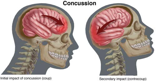 Concussion | Initial impact of concussion (coup) | Secondary impact of concussion (contrcoup)