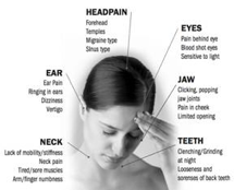 Temporomandibular Joint Dysfunction | TMD