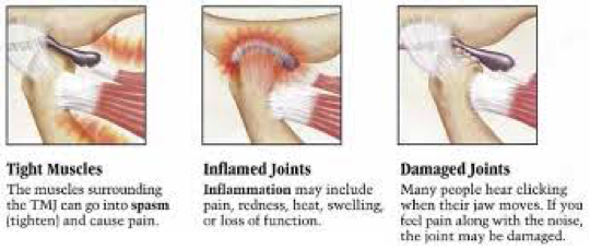 Temporomandibular Joint | TMJ